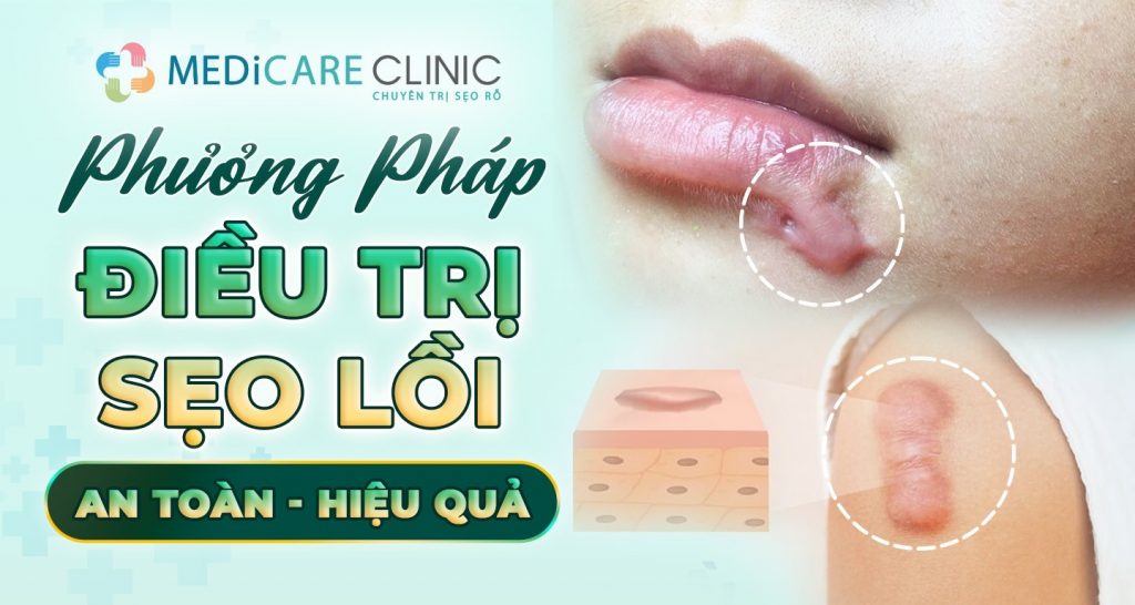 Dieu Tri Sẹo Loi