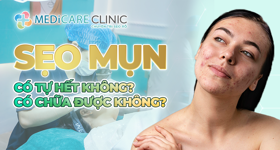 Sẹo Mụn Có Tự Hết Không Có Chữa Được Không