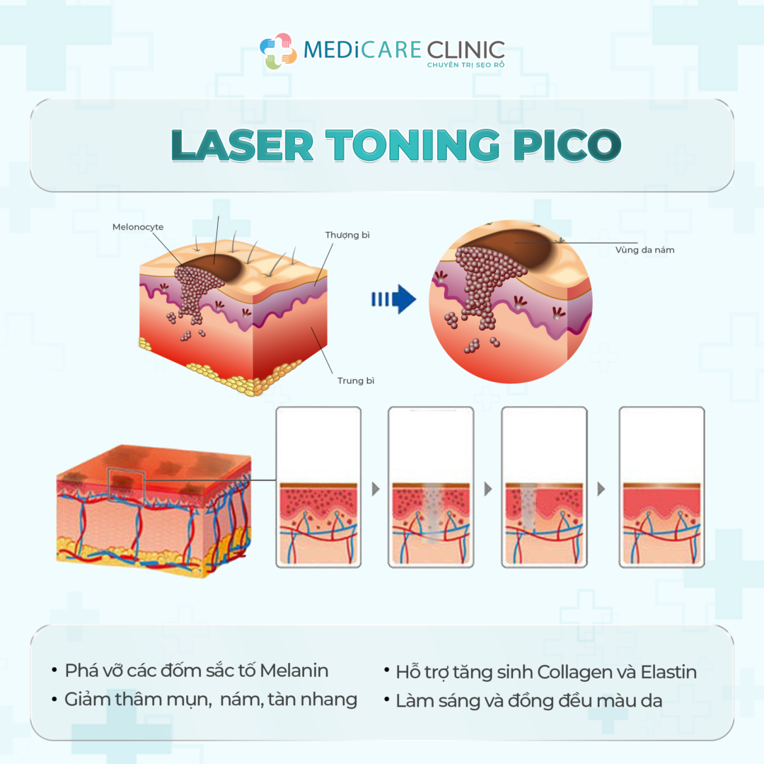 laser toning pico trong điều trị da thâm sạm, nám,...