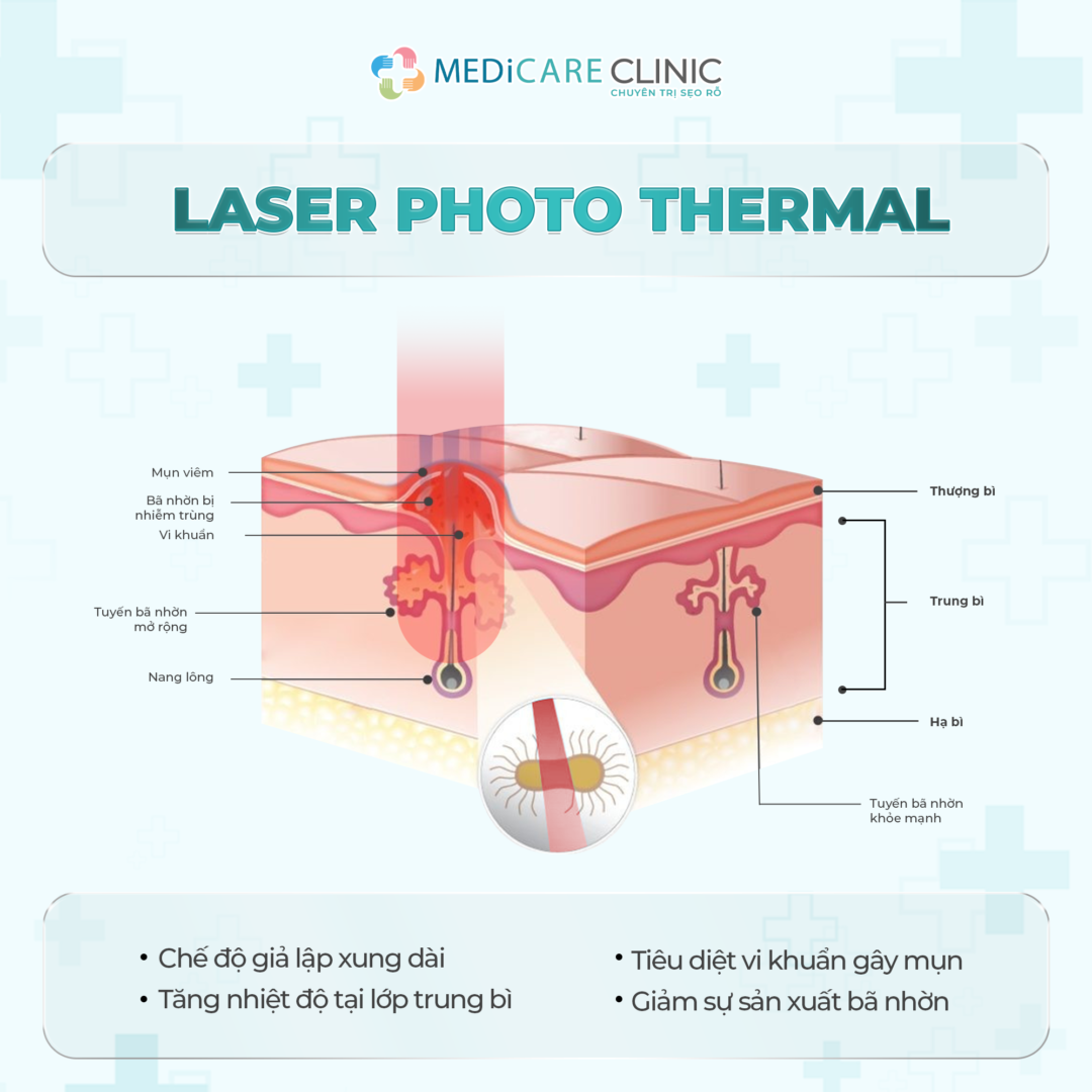 laser photo thermal điều trị da mụn