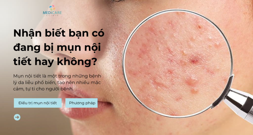 Nhận biết bạn có đang bị mụn nội tiết hay không?