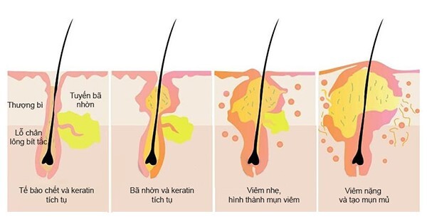 Cơ chế hình thành mụn nội tiết