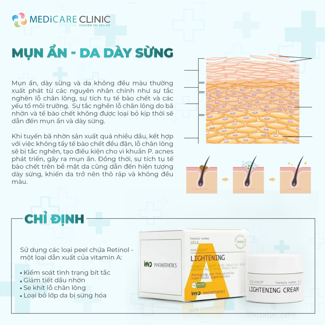 Dòng Peel phù hợp cho Mụn ẩn - da dày sừng