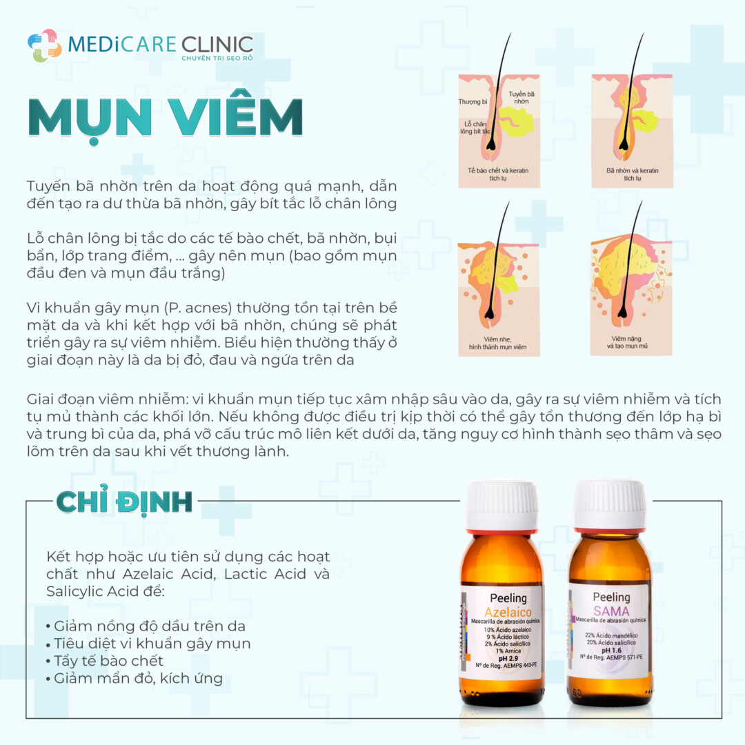 Chemical Peel điều trị mụn viêm