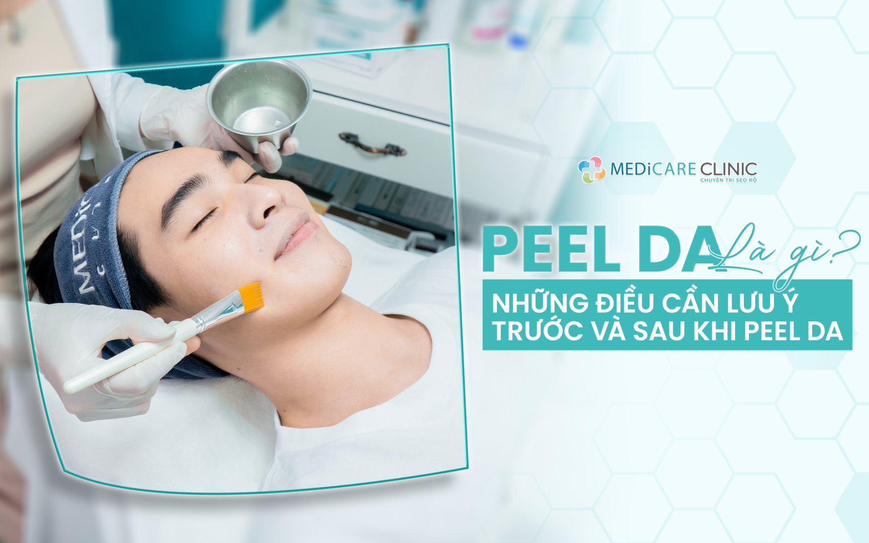 Peel Da Là Gì? Những Điều Cần Lưu Ý Trước Và Sau Khi Peel Da