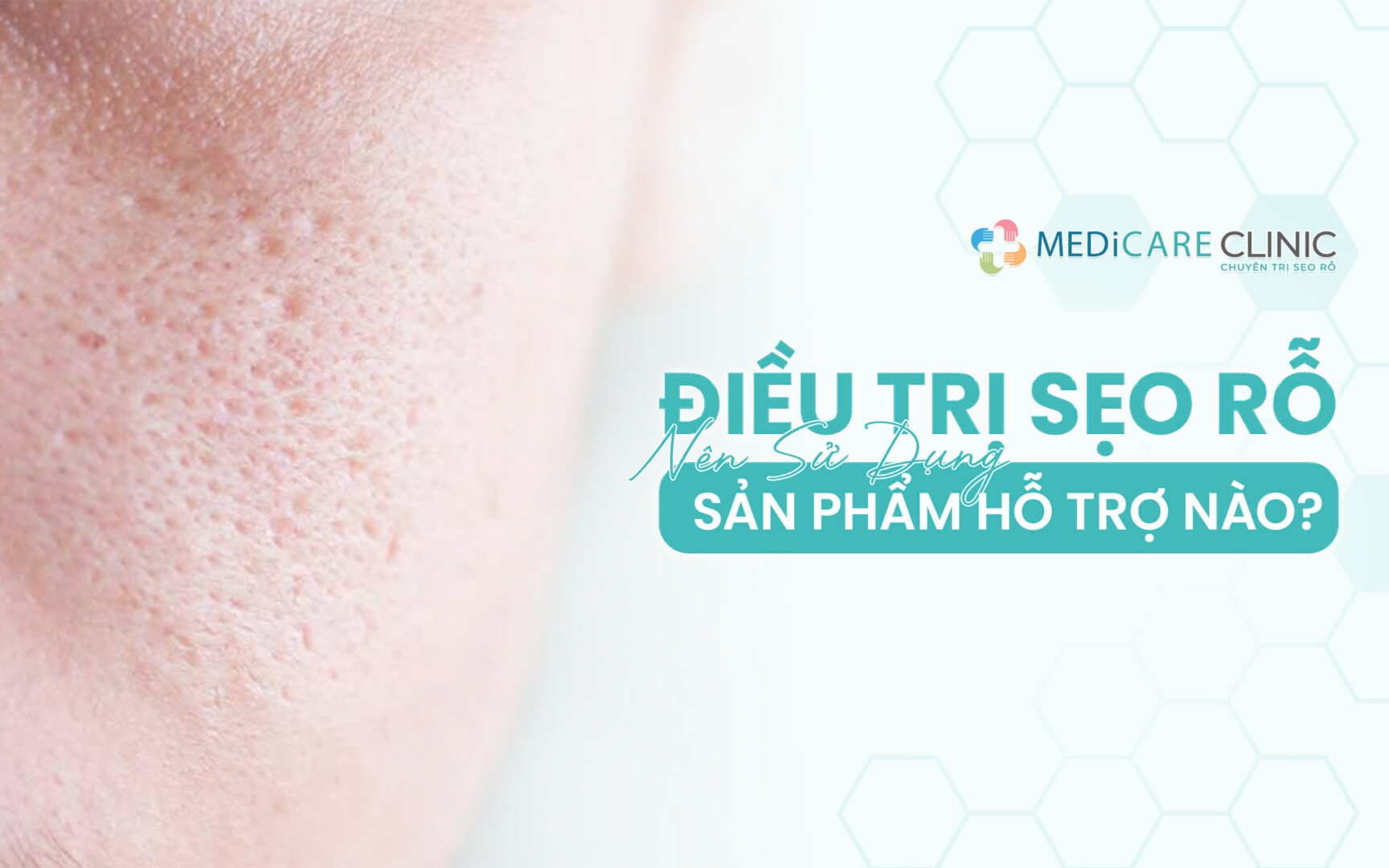 Điều Trị Sẹo Rỗ Nên Sử Dụng Sản Phẩm Hỗ Trợ Nào?
