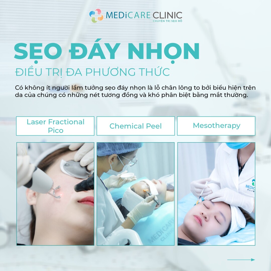 Sẹo đáy nhọn điều trị đa phương thức tại Medicare Clinic